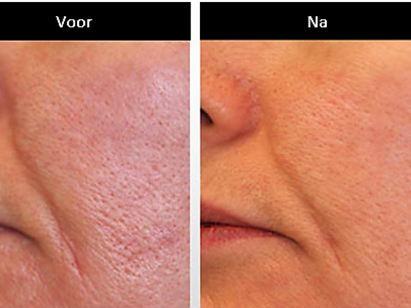 Grote poriën verminderen met dermapen Dermapen behandeling microneedling dermapen ervaringen dermapen voor en na dermapen kosten