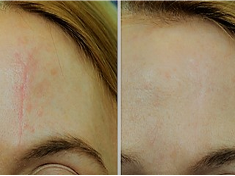litteken verminderen met dermapen Dermapen behandeling microneedling dermapen ervaringen dermapen voor en na dermapen kosten