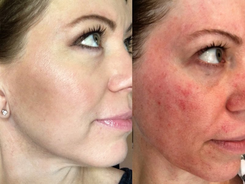 Huidverbetering met dermapen Dermapen behandeling microneedling dermapen ervaringen dermapen voor en na dermapen kosten