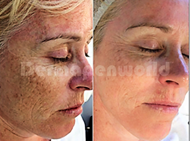 Dermapen behandeling tegen pigmentvlekken Dermapen den haag dermapen microneedling den haag