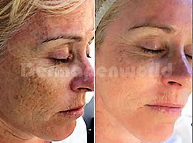 Dermapen den haag dermapen microneedling den haag