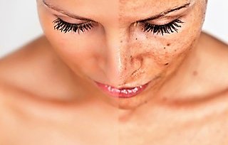 Dermapen huidverbetering dermapen den haag dermapen microneedling den haag