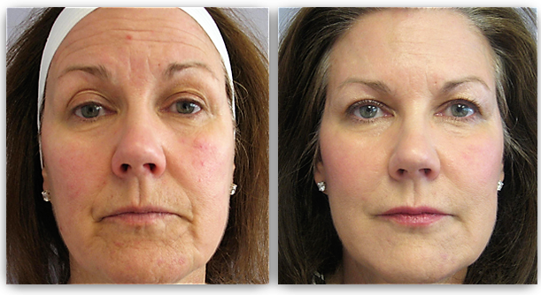 wangen opvullen met fillers fillers den haag wangen opvullen botox den haag plexr den haag dermapen den haag skinboosters den haag peelings den haag