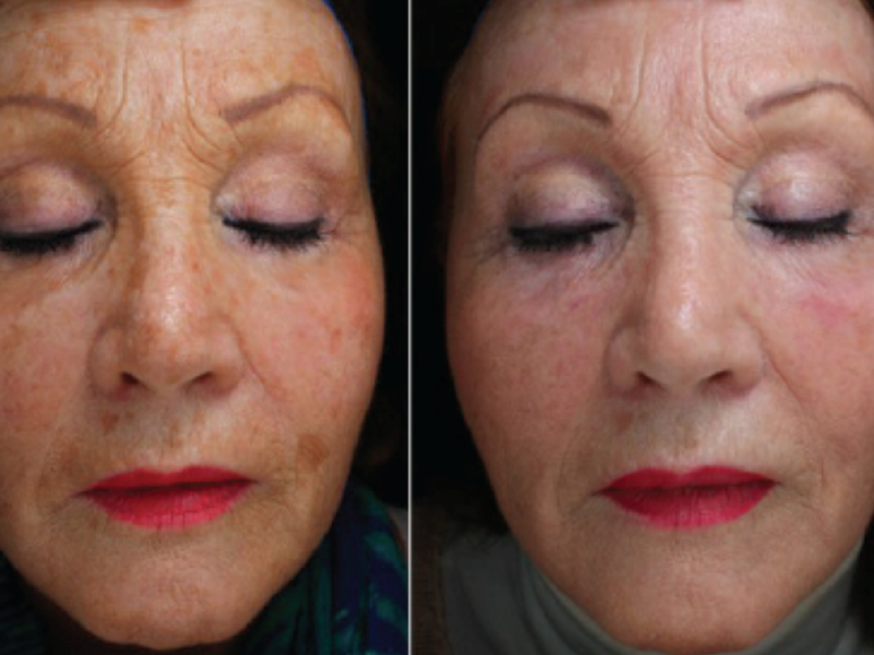 hyperpigmentatie verwijderen met peeling peelings den haag chemische peelings den haag tca peeling den haag gezichts peeling