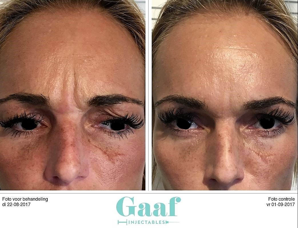 injectables botox voor en na