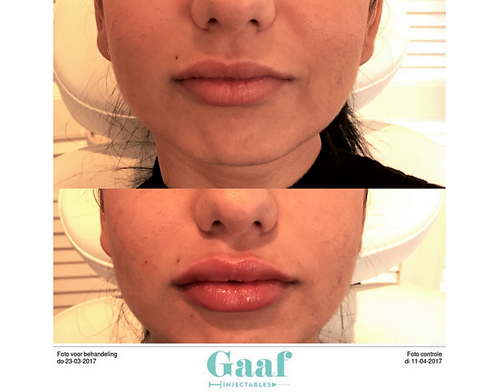 injectables botox voor en na