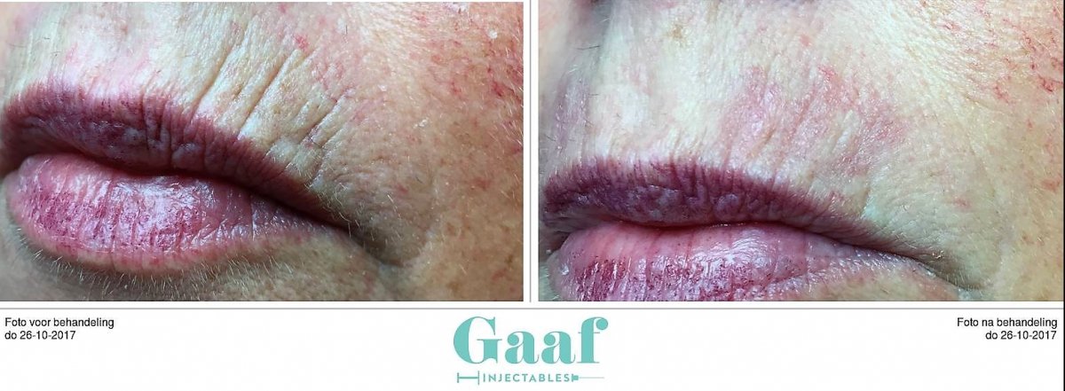 injectables botox voor en na