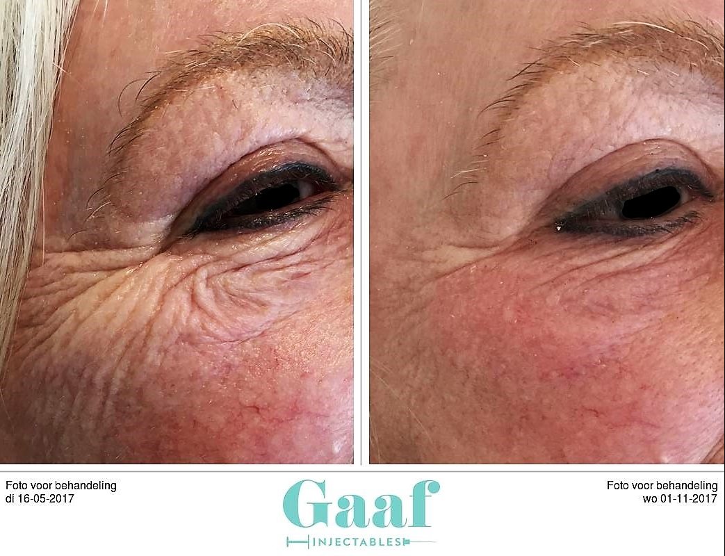 injectables botox voor en na