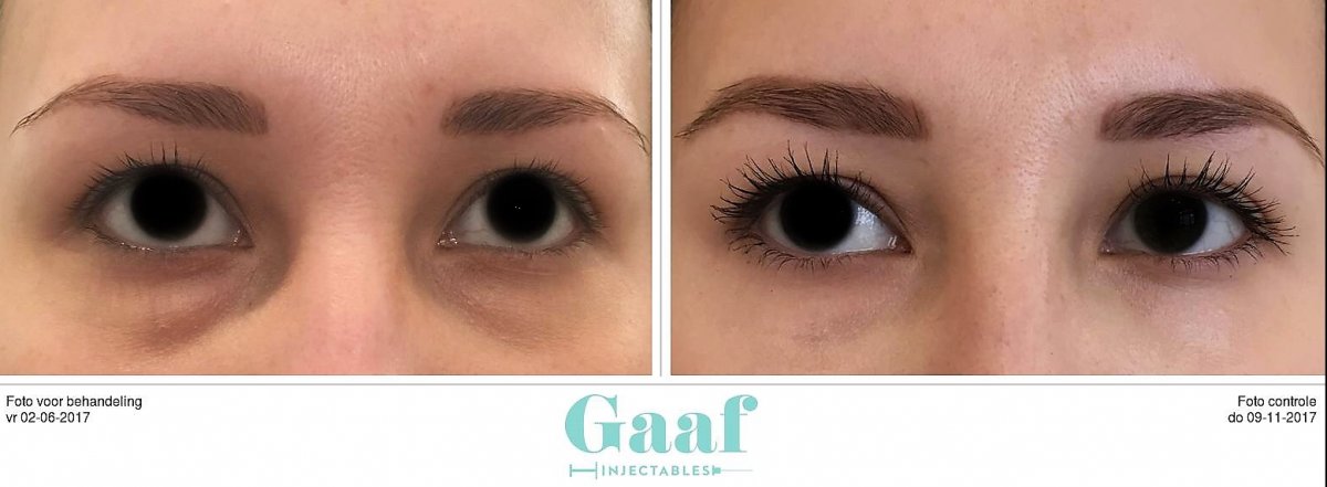 injectables botox voor en na