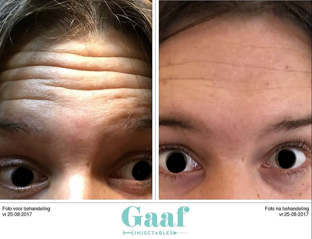 injectables botox voor en na
