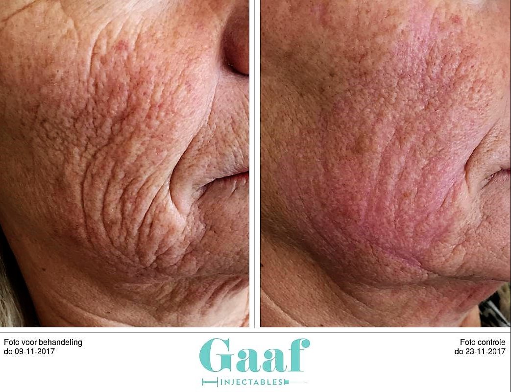 injectables botox voor en na