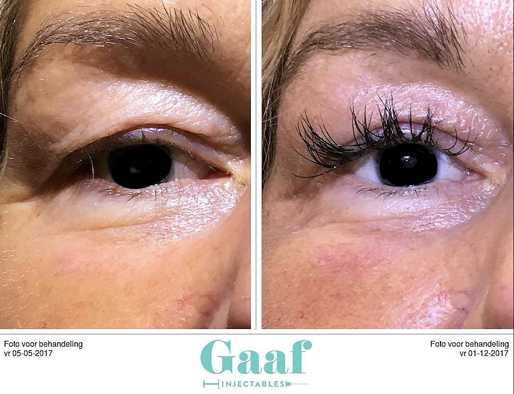 injectables botox voor en na