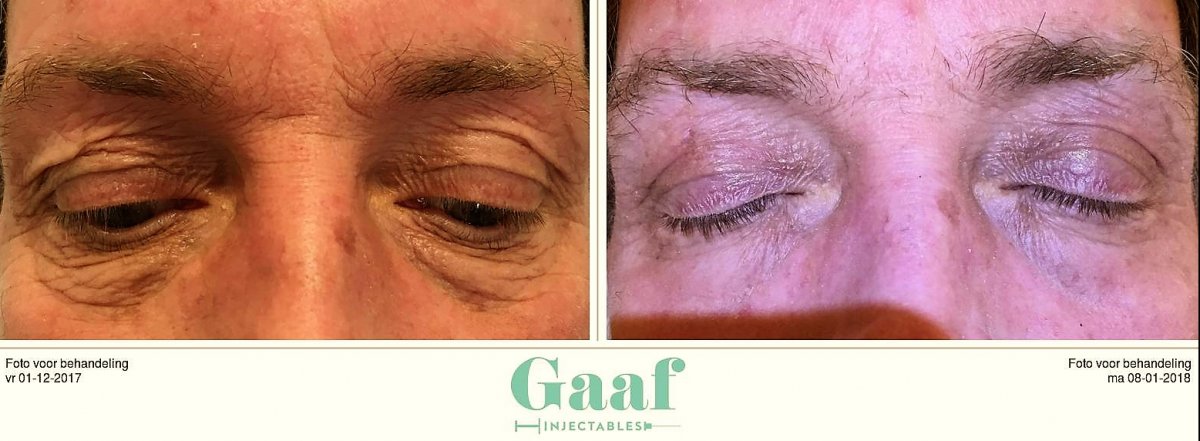 injectables botox voor en na