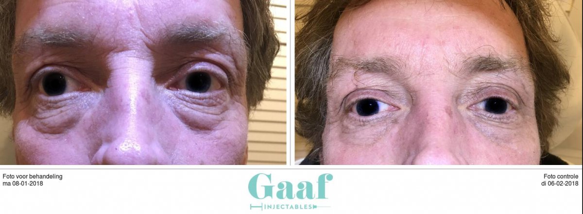 injectables botox voor en na