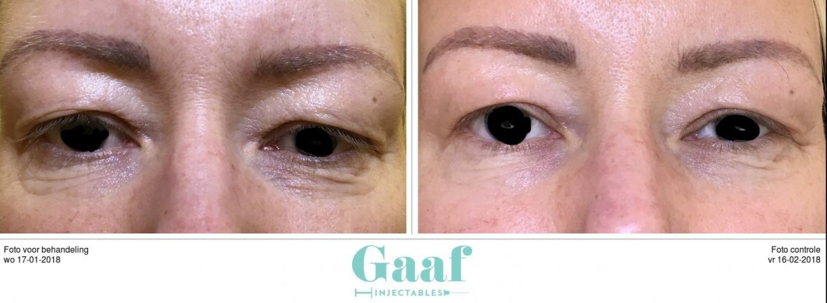 injectables botox voor en na