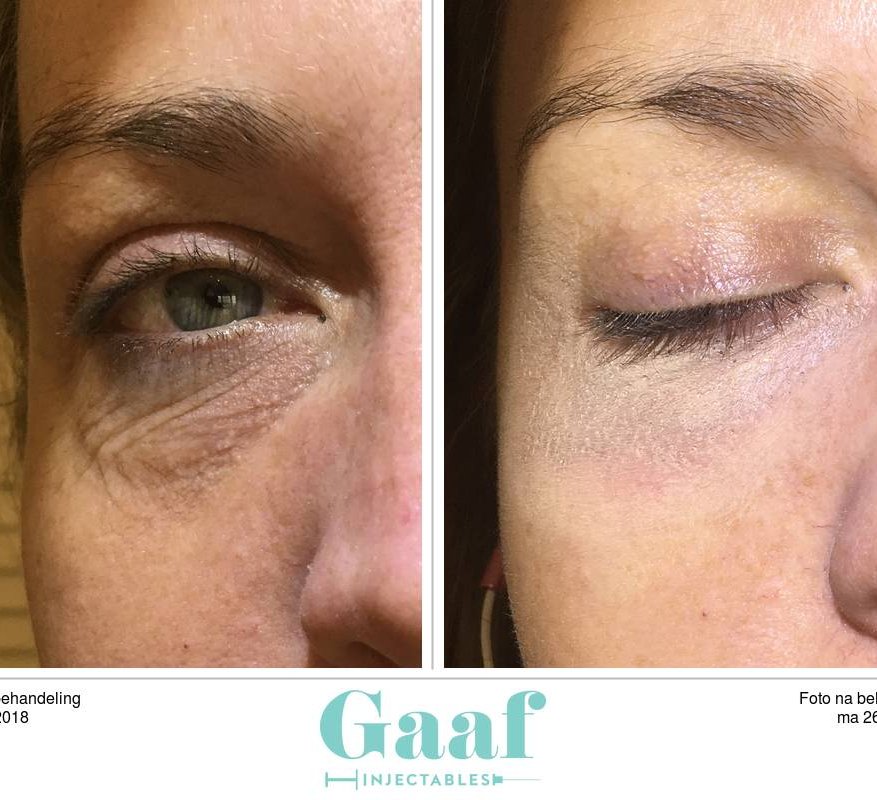 injectables botox voor en na