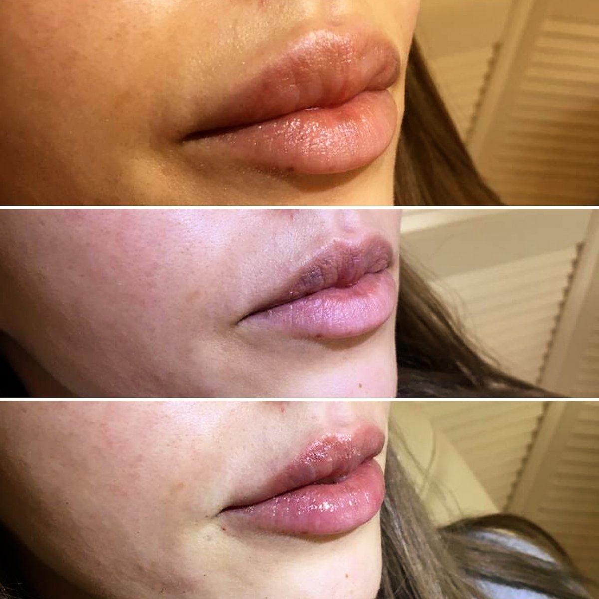 injectables botox voor en na