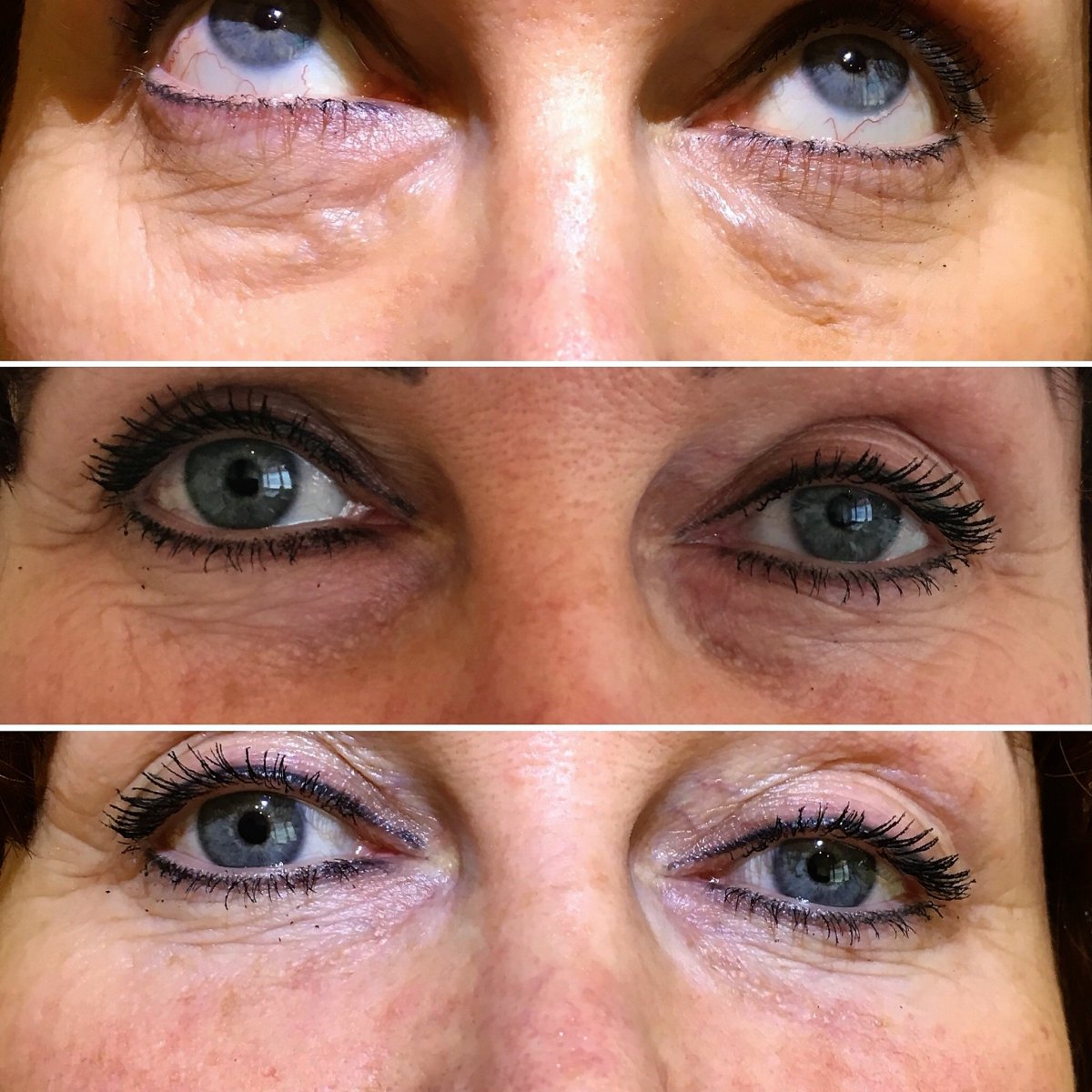 injectables botox voor en na