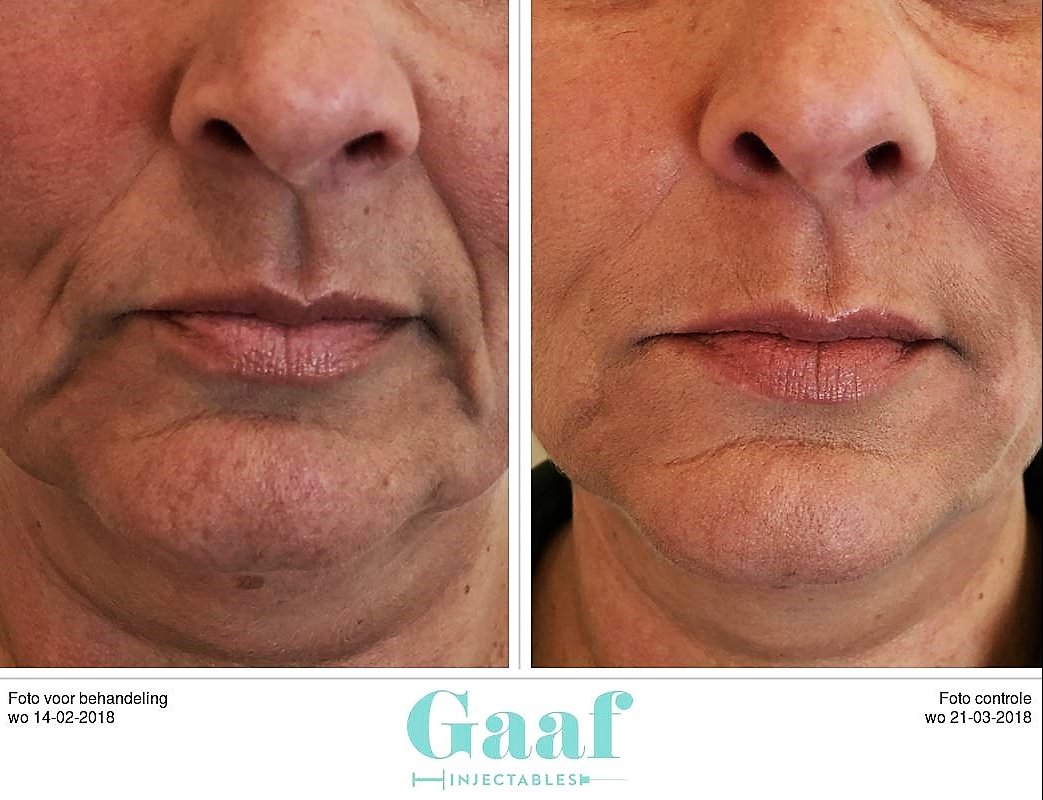 injectables botox voor en na