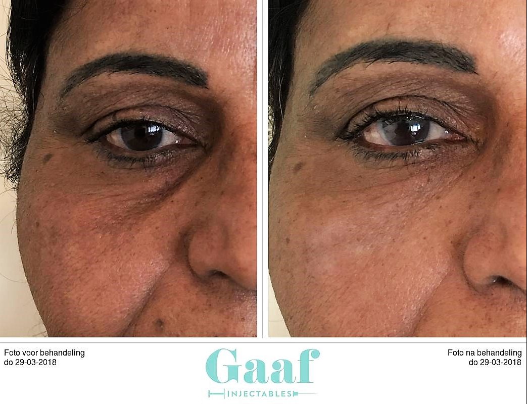 injectables botox voor en na