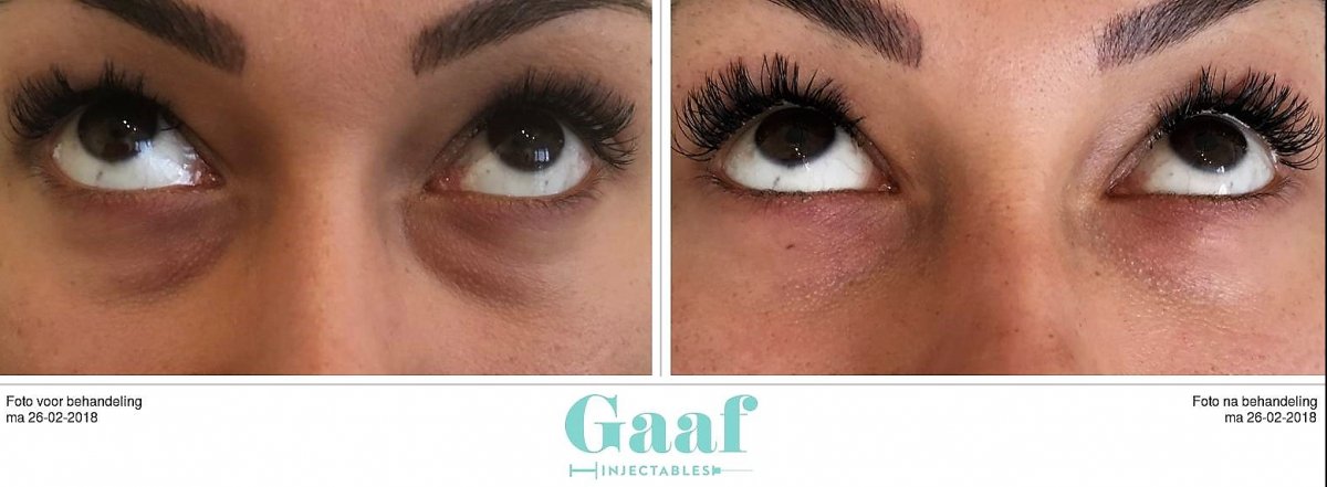 injectables botox voor en na