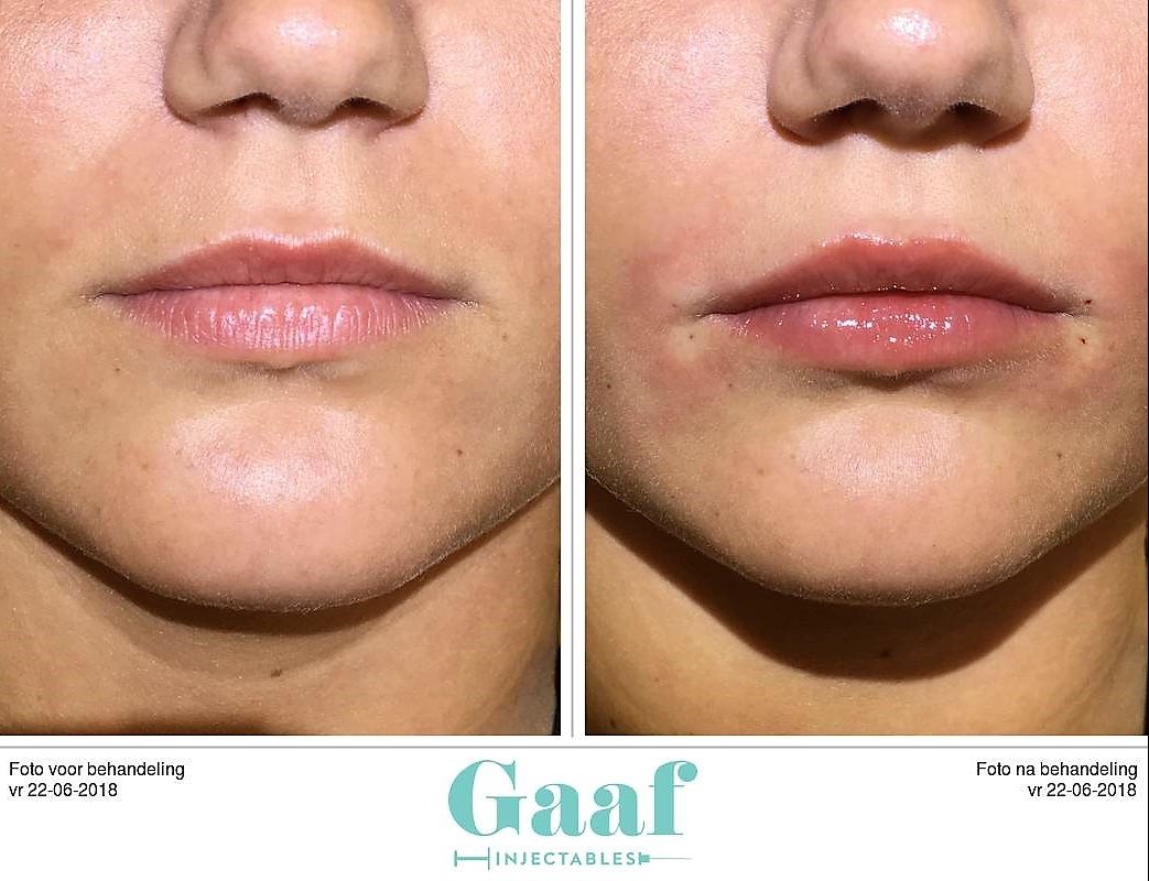 injectables botox voor en na