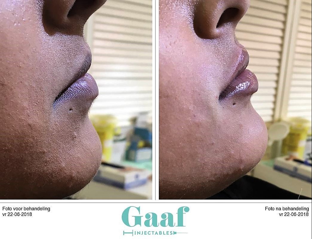 injectables botox voor en na