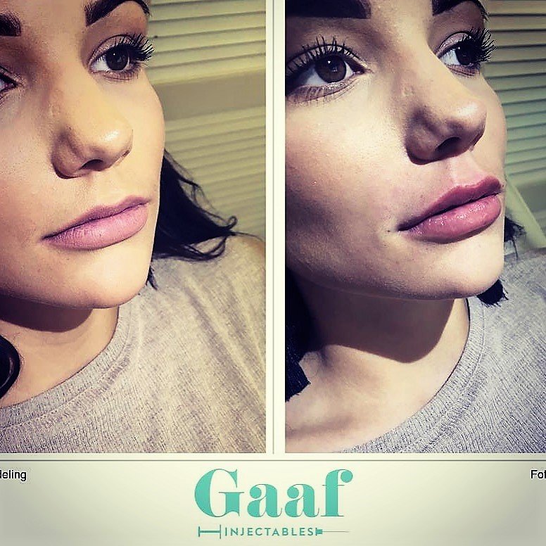 injectables botox voor en na