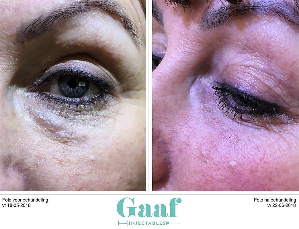 injectables botox voor en na