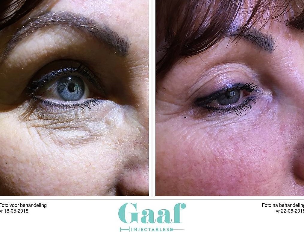 injectables botox voor en na