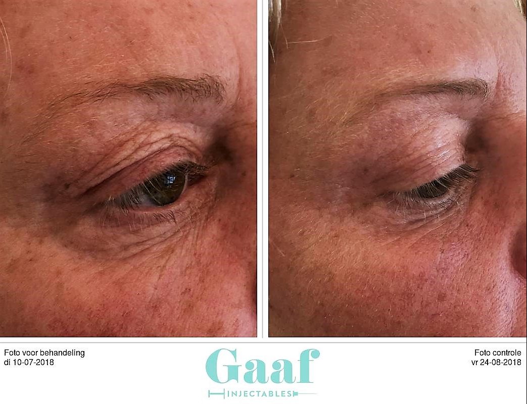 injectables botox voor en na