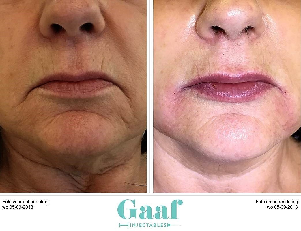 injectables botox voor en na