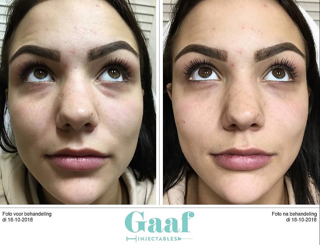 injectables botox voor en na