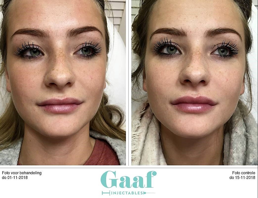 injectables botox voor en na