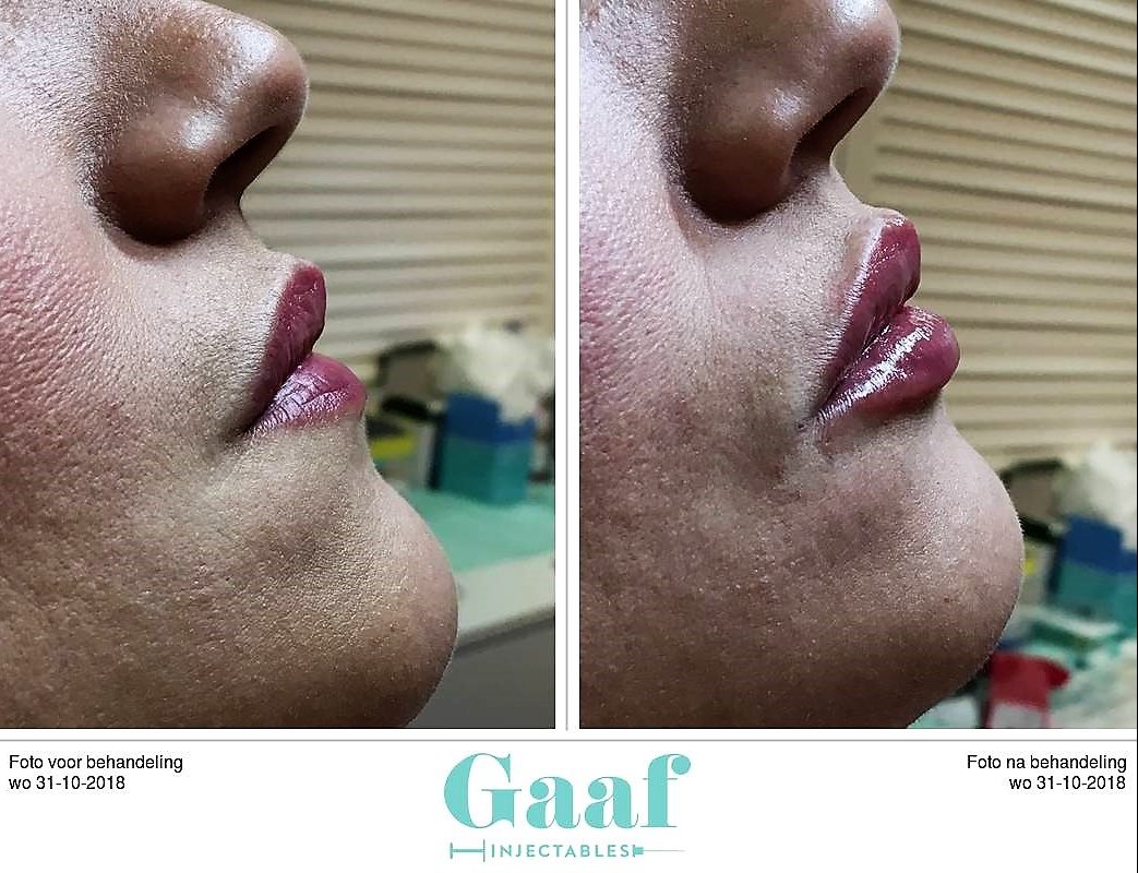 injectables botox voor en na