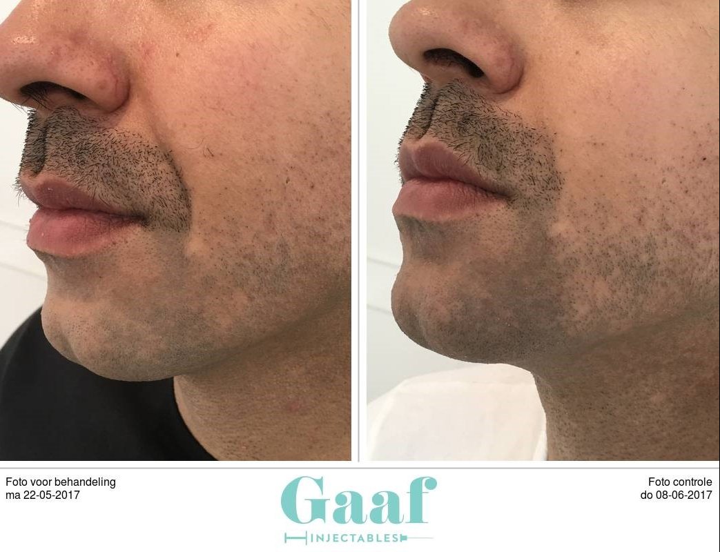 injectables botox voor en na