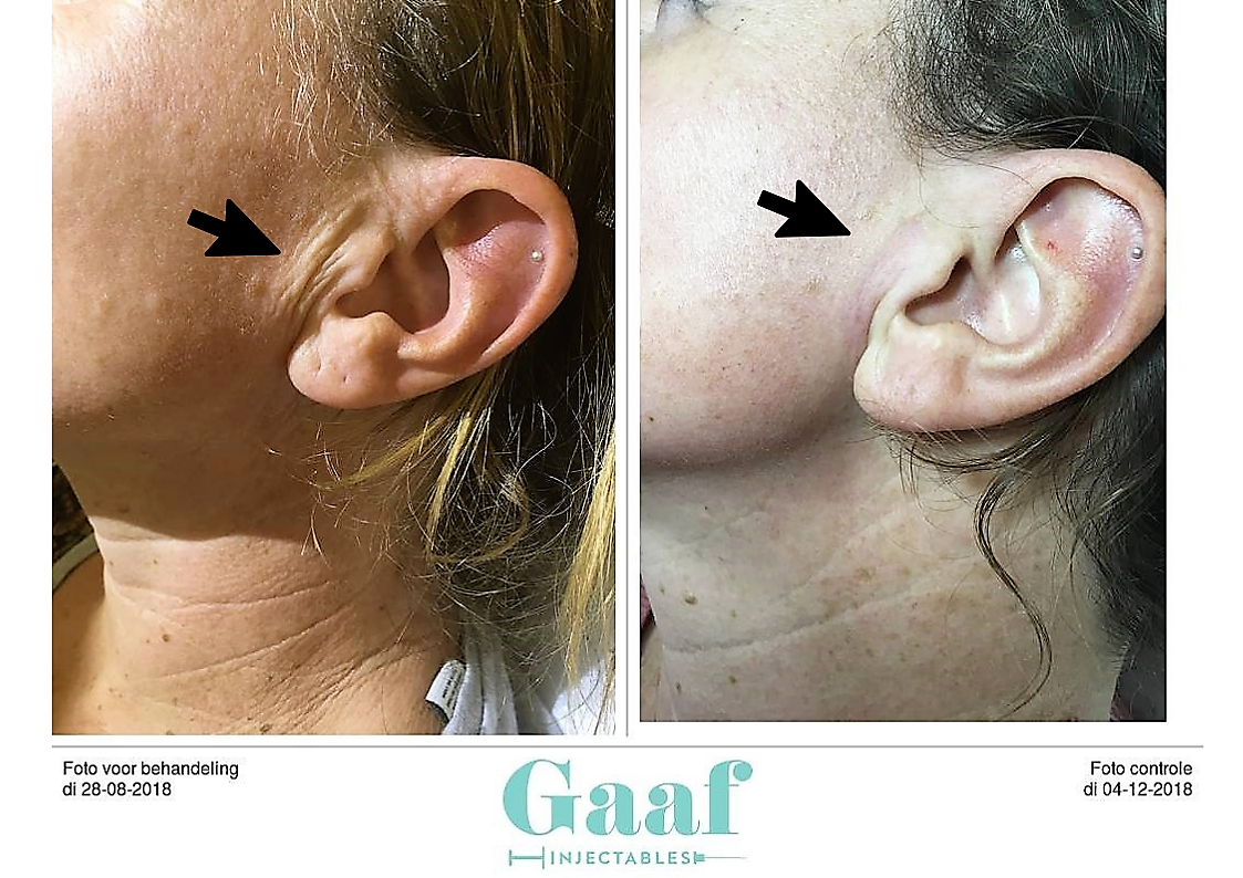 injectables botox voor en na