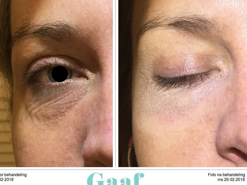 Plexr boven ooglidcorrectie Plexr boven ooglidcorrectie Den Haag ooglift plexr den haag ooglidcorrectie plexr soft surgery plexr ervaringen plexr voor en nadelen plexr wallen