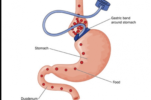 Afvallen met virtuele maagband Virtuele maagband door hypnose en hypnotherapie