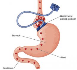 afvallen met de virtuele maagband virtuele maagband Rotterdam Dordrecht