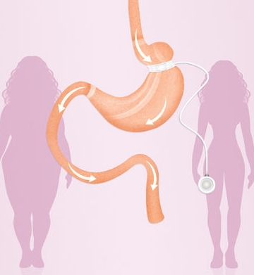 Maag verkleinen virtuele maagband