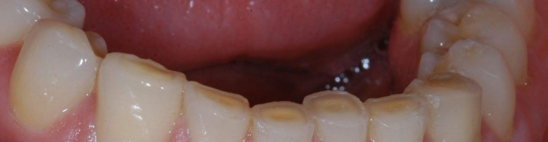 tandenknarsen oplossen met hypnose tandenknarsen oplossen met hypnose en hypnotherapie