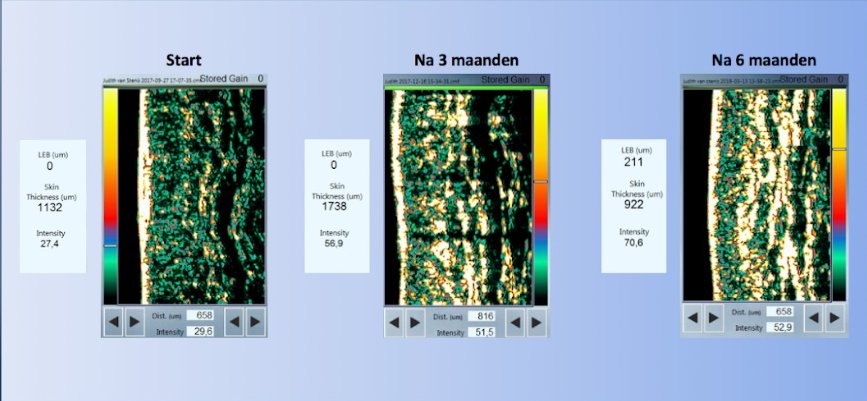 Echo collageen huidscan
