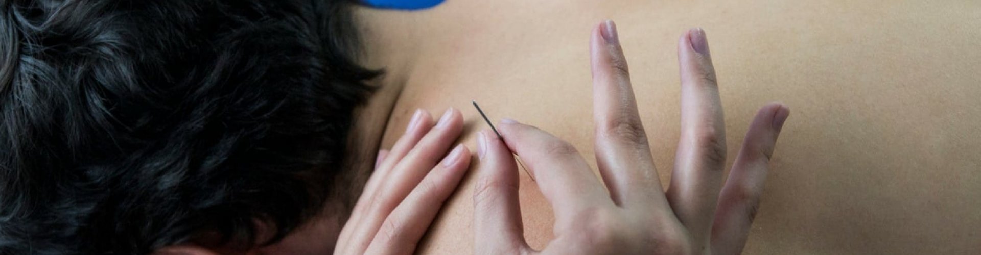 Dry needling osteopaat Dry needling osteopaat