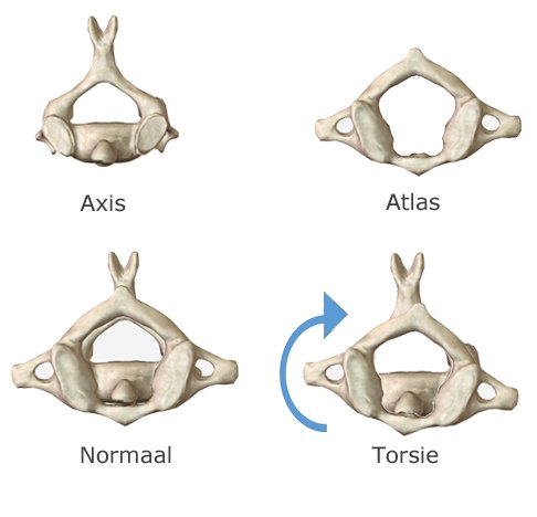 Torsie in de nekwervels Torsie in de nekwervels